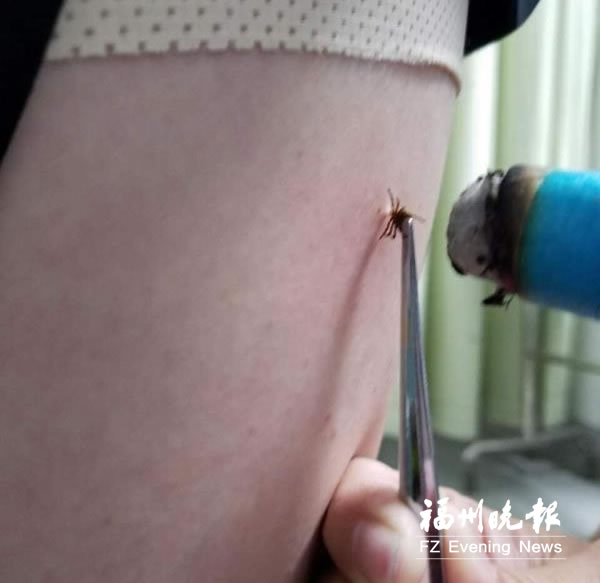 女孩爬山歸來腿上長“痣”竟是蜱蟲　應(yīng)盡快就醫(yī)