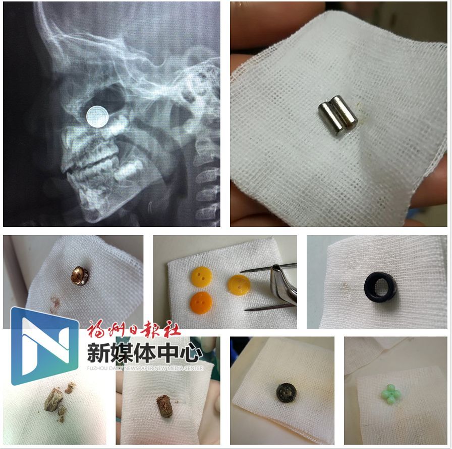 福州4歲男孩吞下2厘米長(zhǎng)釘子……家長(zhǎng)們看緊啦！