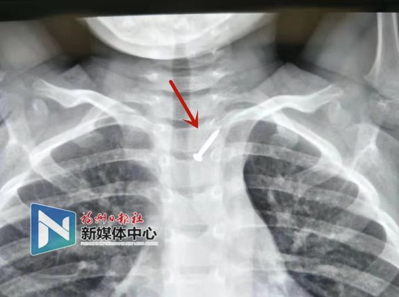 福州4歲男孩吞下2厘米長(zhǎng)釘子……家長(zhǎng)們看緊啦！