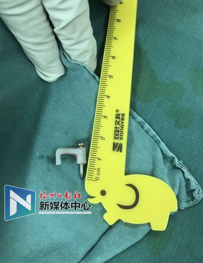 福州4歲男孩吞下2厘米長(zhǎng)釘子……家長(zhǎng)們看緊啦！
