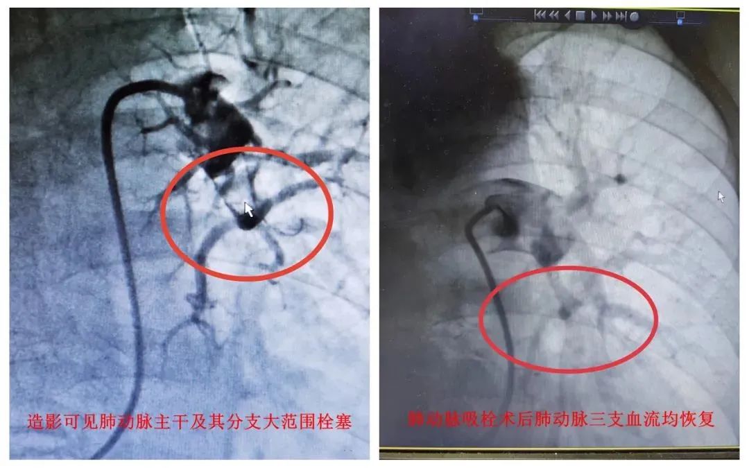 “陽”后一個月，這類風(fēng)險增加33倍！