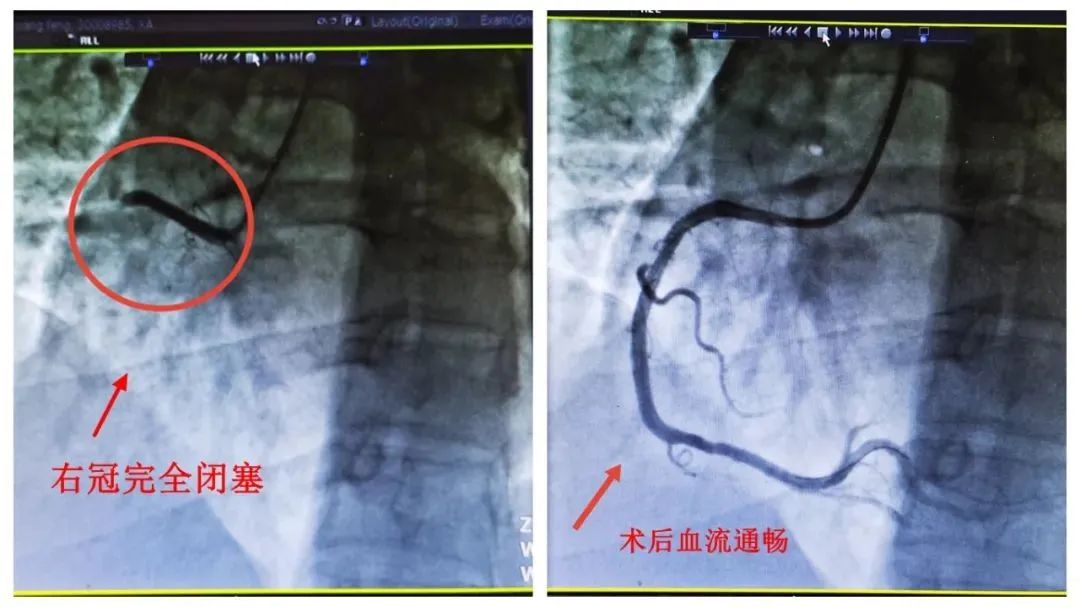 “陽”后一個月，這類風(fēng)險增加33倍！