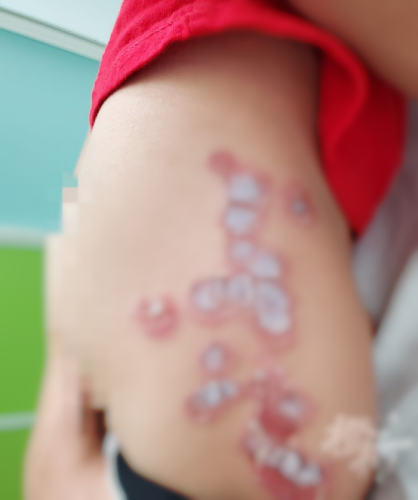 3歲孩子皮膚潰爛！一經(jīng)接觸就會(huì)傳染……緊急提醒！